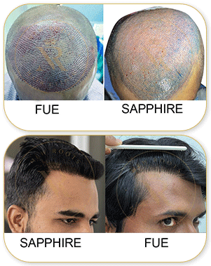 Sapphire FUE Before After